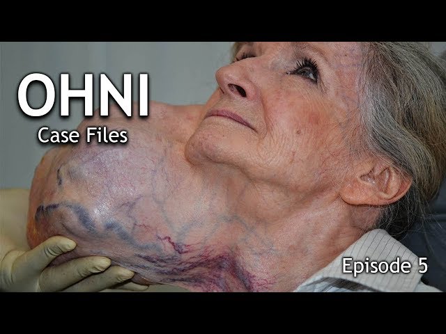 A Documentary About a Woman With a Giant Parotid Tumor Has Surgery