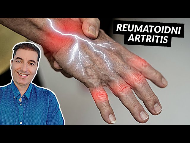 The Ultimate Secret to Cure Rheumatoid Arthritis