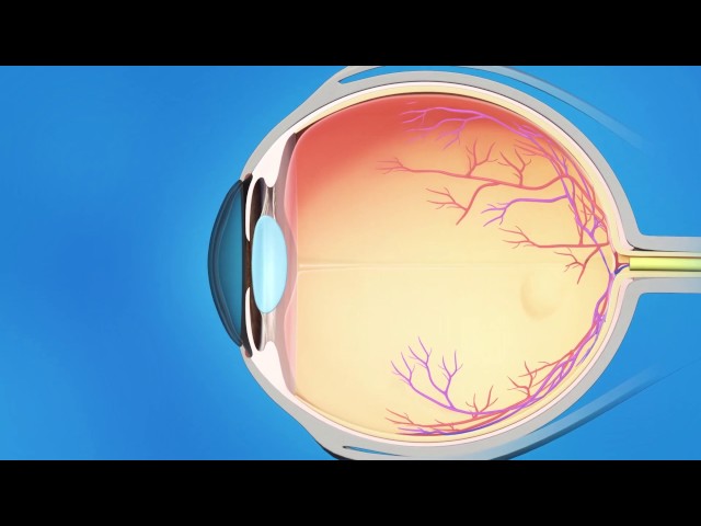 Glaucoma Implant Surgery