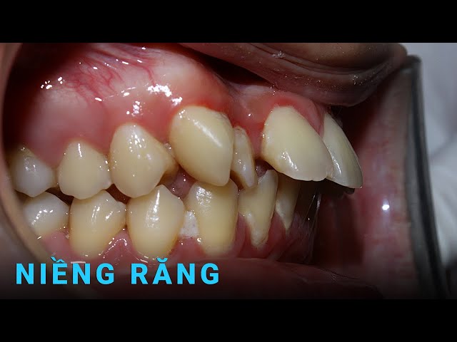 Trước và sau niềng răng hô | Orthodontic before after