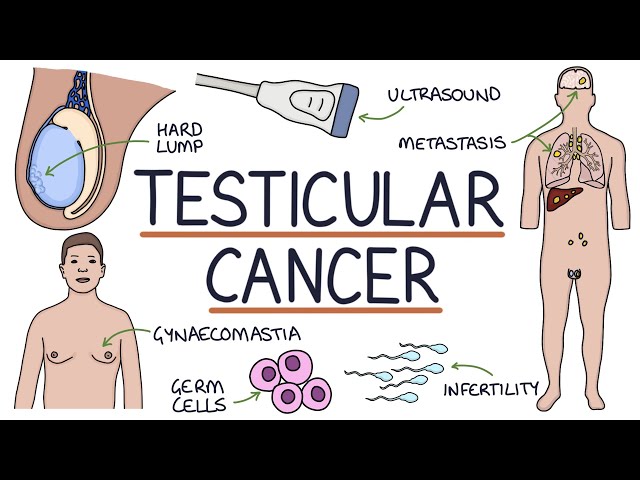 Understanding Testicular Cancer