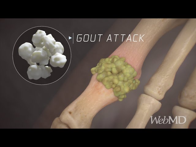 What Happens During a Gout Attack | WebMD