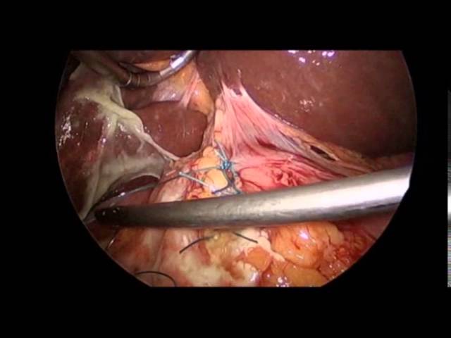 Laparoscopic surgery repair of perforated pre pyloric gastric ulcer by Dr. Iraniha