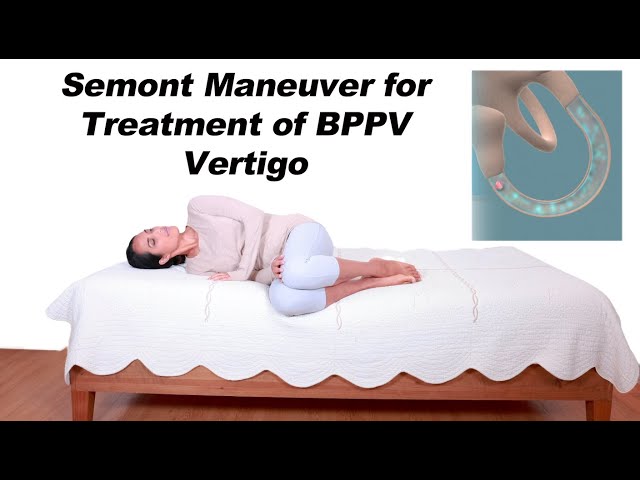 Semont Maneuver for BPPV Vertigo Treatment (Alternative to Epley Maneuver)