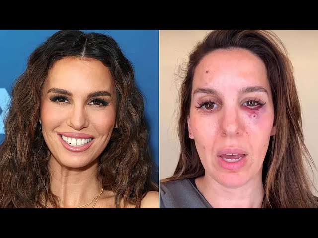 Christy Carlson Romano was hit in the eye while clay shooting on her husband's birthday.