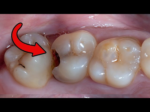 Các bước trám răng | step by step posterior composite filling