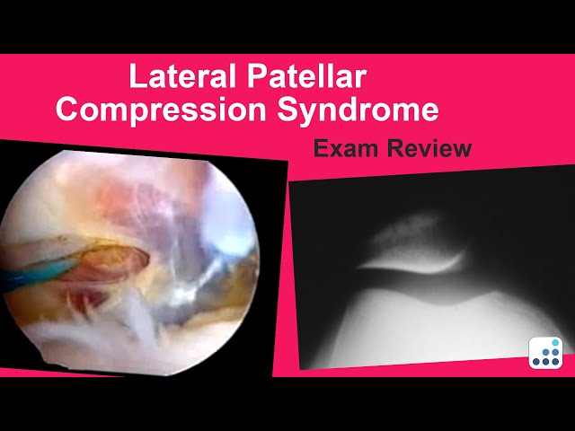 Lateral Patellar Compression Syndrome Exam Review - C. Lowry Barnes, MD