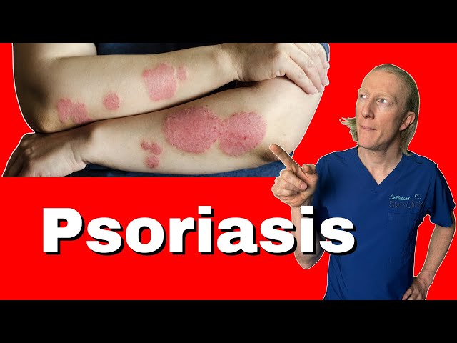 Understanding Psoriasis: Causes, Symptoms, and Effective Treatments