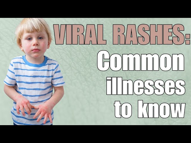 Pediatrician Explains Viral Rashes and Fifth Disease and Sixth Disease (Roseola)