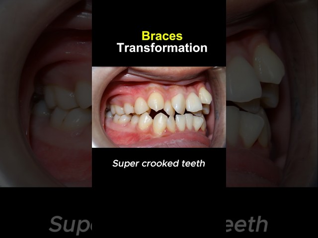 Super crooked teeth after braces #orthodontist #dentist #braces #dentisty