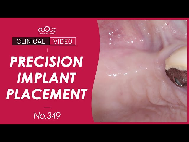 Precision Implant Placement in #15, #16 with Stopper System [Dr. Na Kiwon]