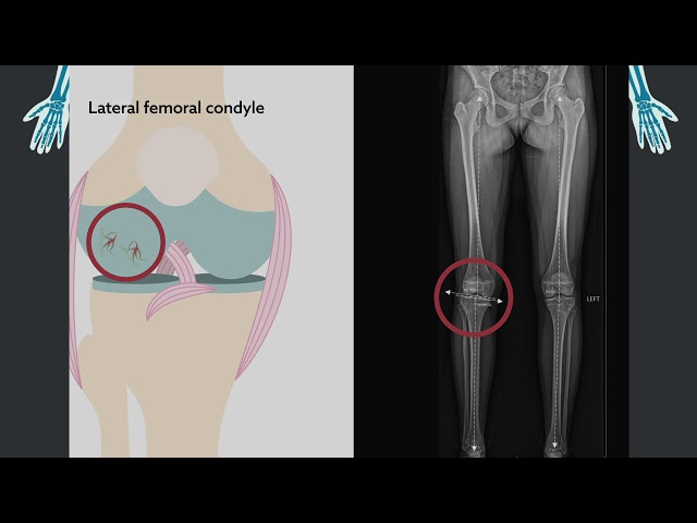 Abnormal alignment of lower extremity associated with osteochondritis dissecans