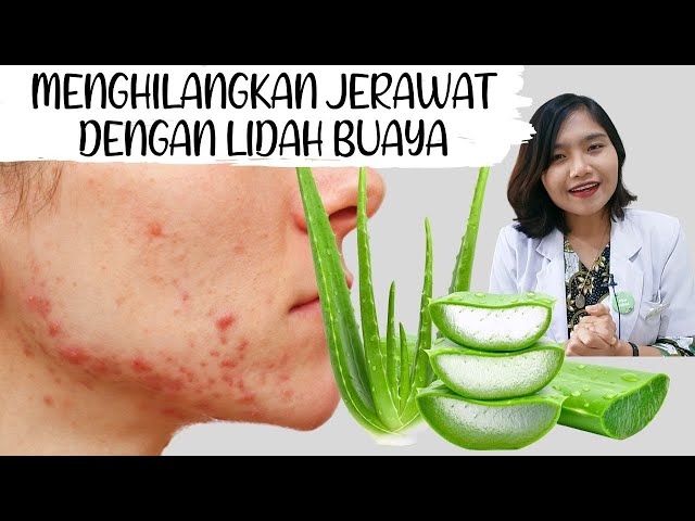 DIY Aloe Vera untuk Jerawat - Cara Pakai Lidah Buaya dirumah  | dr. Emasuperr