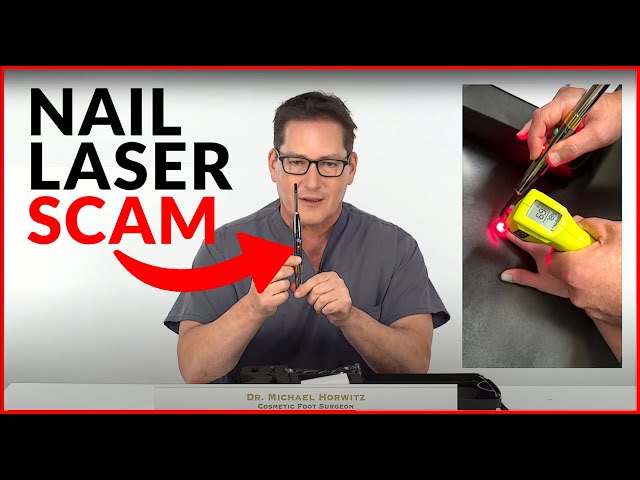 Nail Laser Scams: DIY - Home Fungus Toenail Lasers - Do They Really Work?