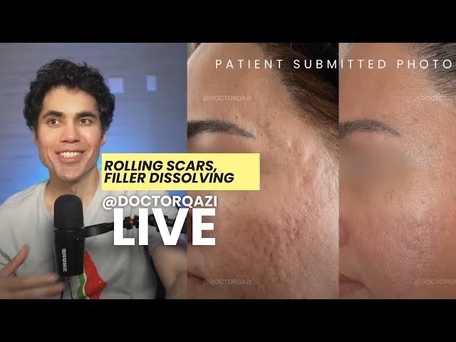 Dr. Qazi discusses Rolling Scars, Filler Dissolving, TCA Cross| Dr. Qazi Unsponsored Live | 2.6.2025