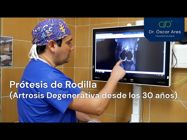 Prótesis de Rodilla  - Artrosis Degenerativa desde los 30 años - Dr. Oscar Ares