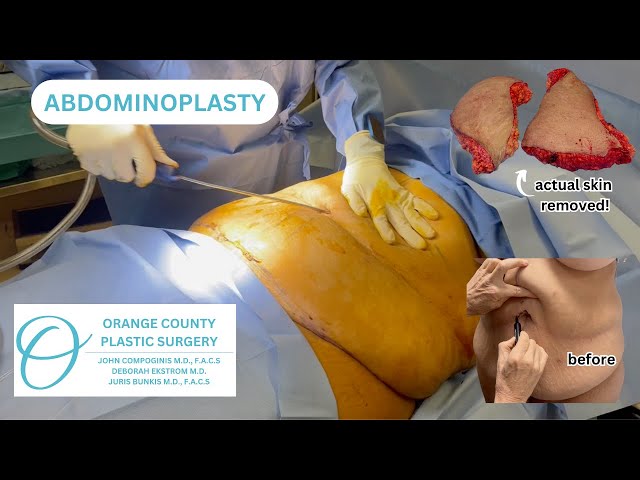 Abdominoplasty (Tummy Tuck) #tummytucksurgery #tummytuckrecovery #tummytuckbeforeandafter