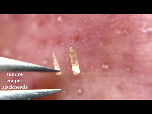 鼻角栓118.2nose blackheads（Larger version）★Tweezers only★