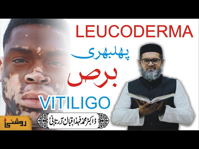 VITILIGO, LEUCODERMA AUR BARS KA ASAN QUDRATI ROOHANI ILAJ - Dr. FAHAD ARTANI ROSHNIWALA