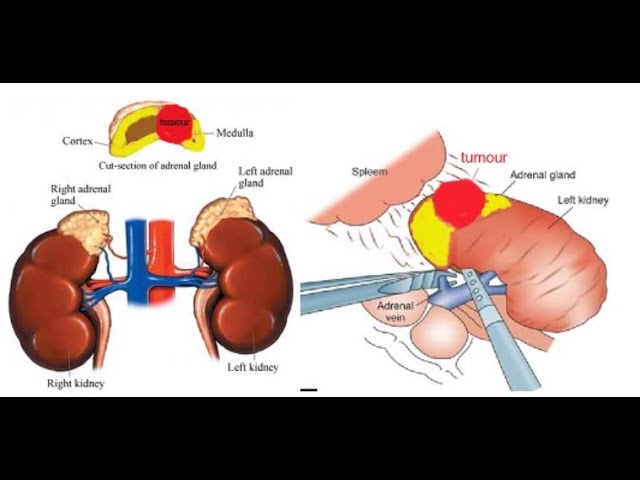 Adrenalectomy: Surgical Removal of the Adrenal Glands