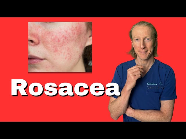 Your Guide to Rosacea: From Skin Redness to Emotional Wellness