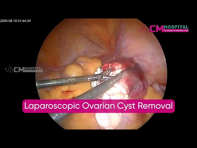 Laparoscopic Ovarian Cyst Removal | CM Hospital | Chennai