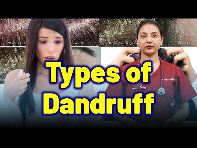 Types of Dandruff. | Treatment & Cure | Homeopathy, Medicine & Surgery