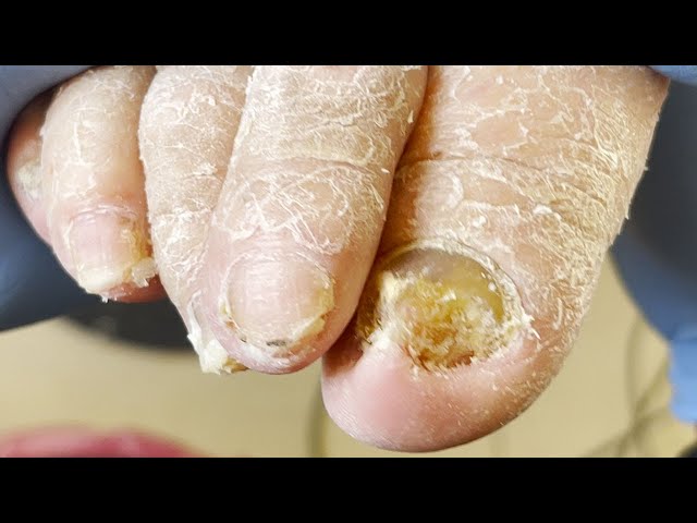 Thick yellowing toenails, digging out huge ingrown toenails