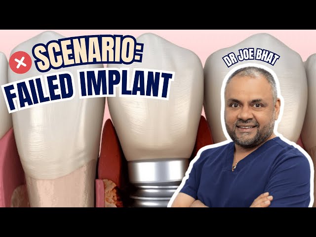 Implant Failed After 6 Months - Surgeon vs Restorative Dentist Medicolegal Considerations - GF022