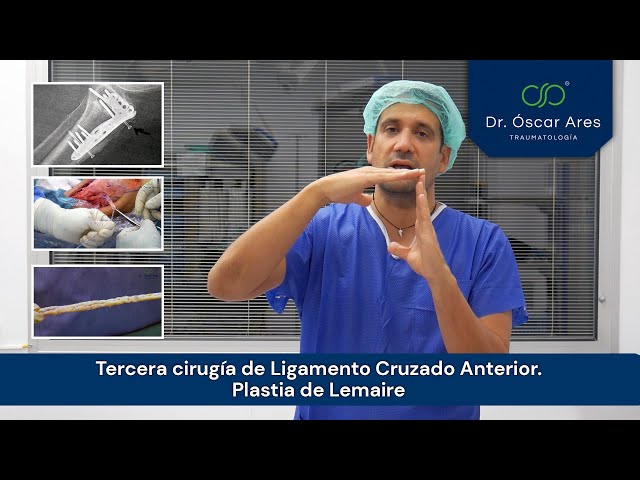 Tercera cirugía de Ligamento Cruzado Anterior. Plastia de Lemaire - Dr. Oscar Ares