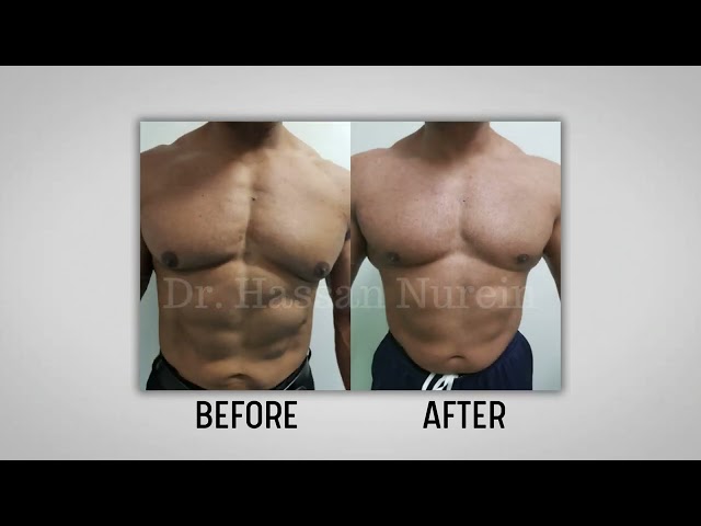 Gynecomastia Surgery Transformations with Dr Hassan Nurein