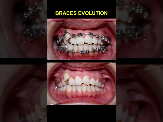 Braces transformation, croooked teeth #braces #orthodontist #bracket #dentist