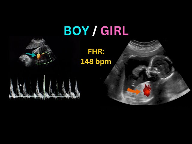 Heartbeat Ultrasound | Boy or Girl Gender Prediction | Fetal Heartbeat Sound