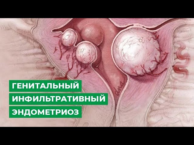 Что вы никогда не знали о генитальном инфильтративном эндометриозе