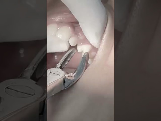 Extraction of first premolar for orthodontic treatment #satisfying