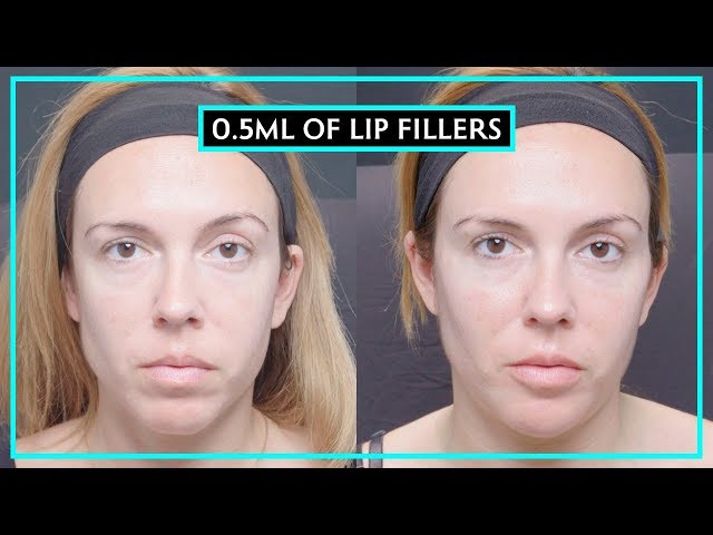 How Much Difference Does 0.5ML Of Lip Fillers Make?