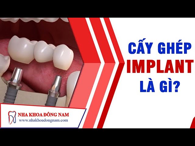 Cấy Ghép Răng Implant Là Gì? | NHA KHOA ĐÔNG NAM®