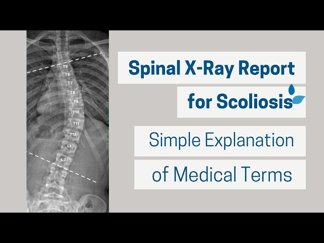 Spinal X-Ray for Scoliosis | Simple Explanation of Medical Terms