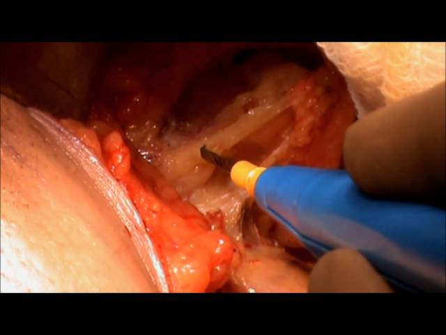 Axillary Dissection in Breast Conservation Surgery-Bloodless Whitefield Surg Dissection- R Talwar