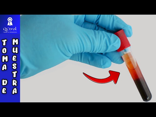 HEMOLYSIS of samples: Causes and recommendations