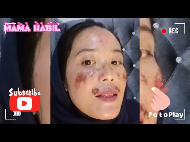 CHEMICAL PEELING H4  MENGHILANGKAN FLEK hari KE EMPAT