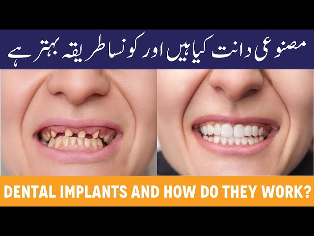 Dental Implants Kya Hain?- Daant Lagwane Ka Sahi Tarika - Permanent Tooth Replacement Explained