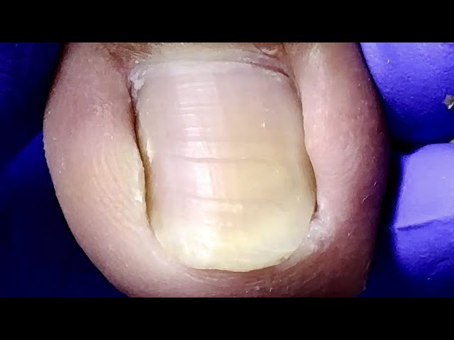 The middle of the nail is embedded, very rare, how to trim it without injury【Doctor Liu Pedicure】