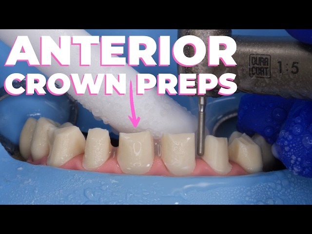 How To: Anterior Crown Preps with Dr. Lincoln Harris