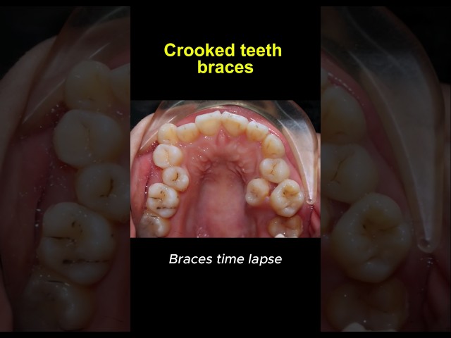 Braces time lapse, crooked teeth transformation #braces #orthodontist #brackets #dentist #dentistry