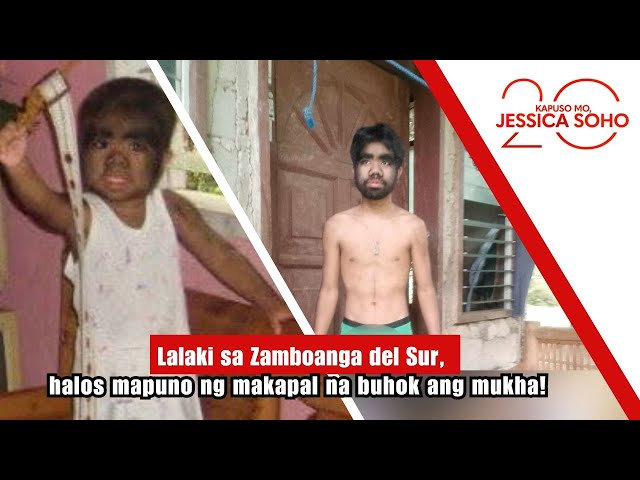 Lalaki sa Zamboanga del Sur, halos mapuno ng makapal na buhok ang mukha! | Kapuso Mo, Jessica Soho