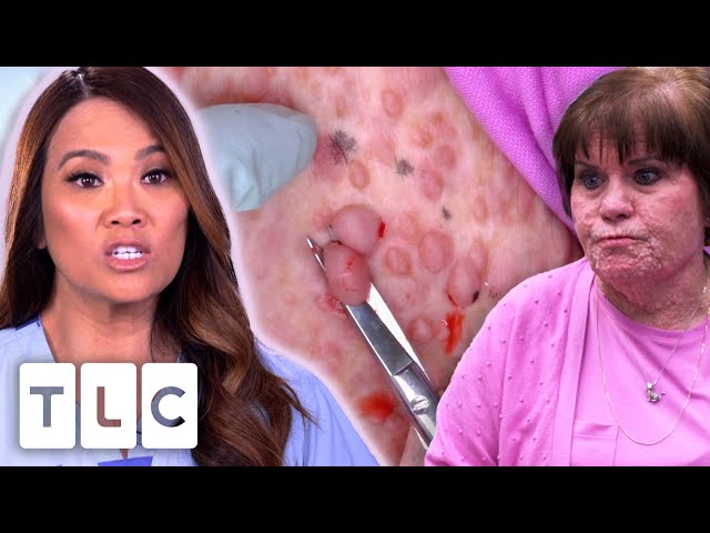 Dr. Lee Removes As Many Bumps As Possible From A Woman's Face | Dr. Pimple Popper | UNCENSORED | 18+