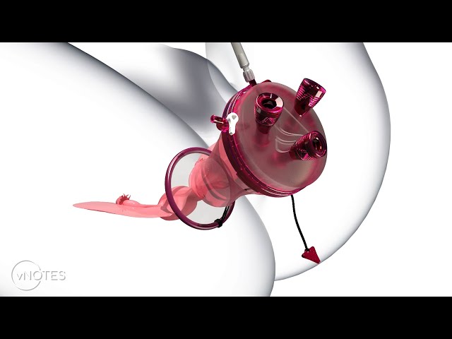 vNOTES Hysterectomy Animation | Featuring the GelPOINT V-Path Platform and the Voyant System