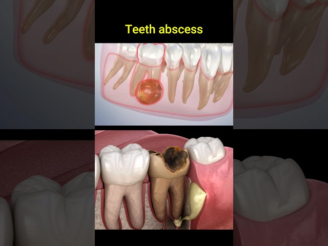 Tooth abscess problem #dentist #dentisty #teeth #dental