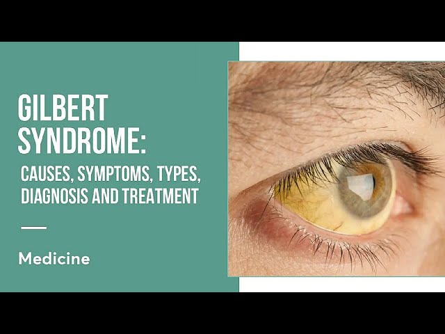 Gilbert's Syndrome: जानिए इसके लक्षण और उपचार